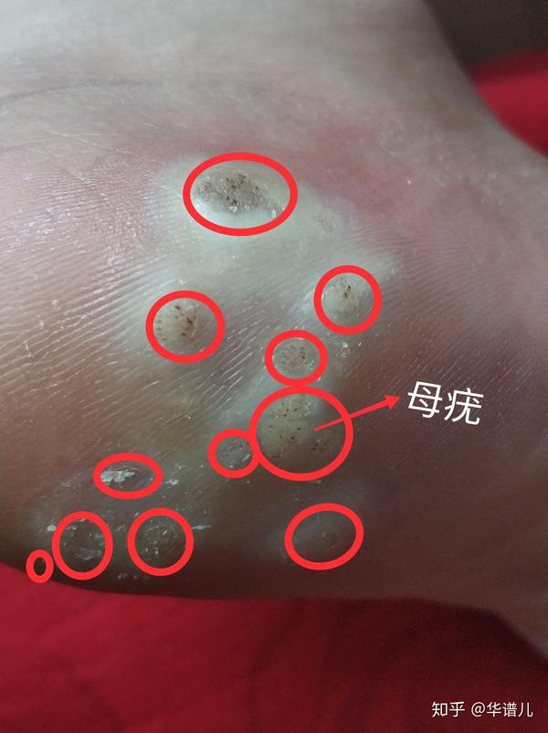 几毛钱的东西轻松治跖疣
