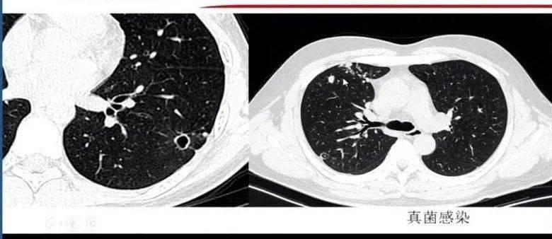 图8 肺结核表影像学表现