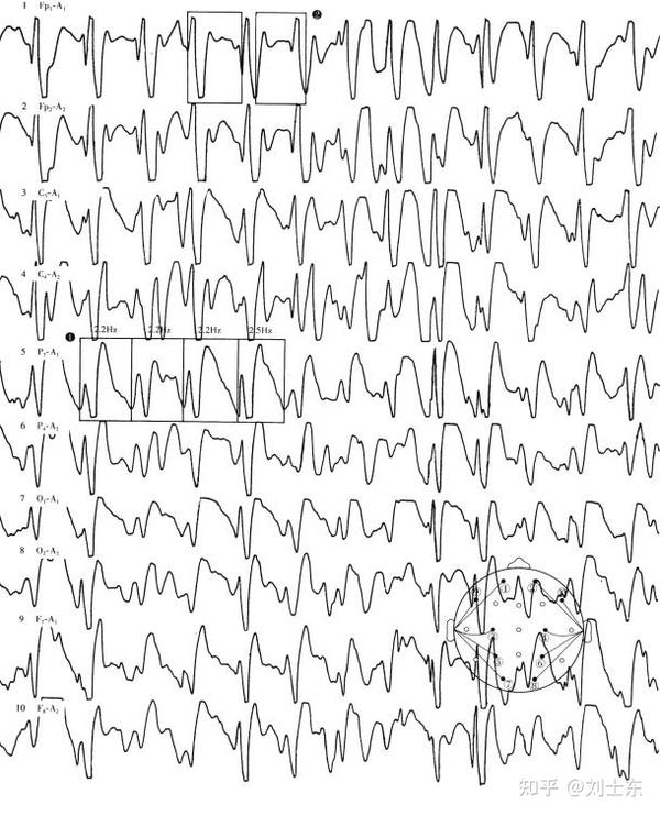 小儿脑电图判读(精述)