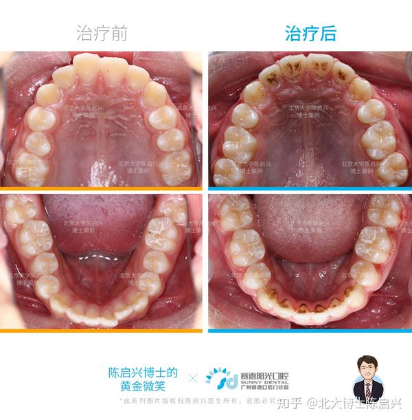 "龅牙仔"秒变"靓仔",论牙齿对颜值的重要性!