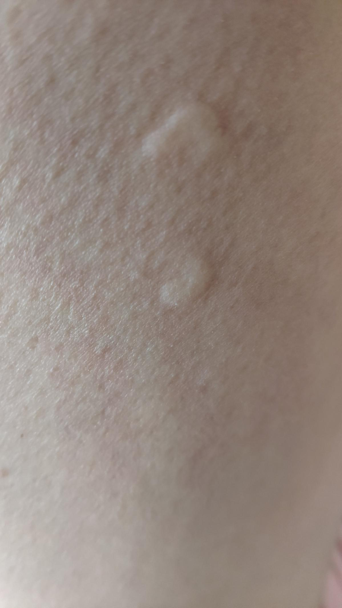 荨麻疹能治愈吗?