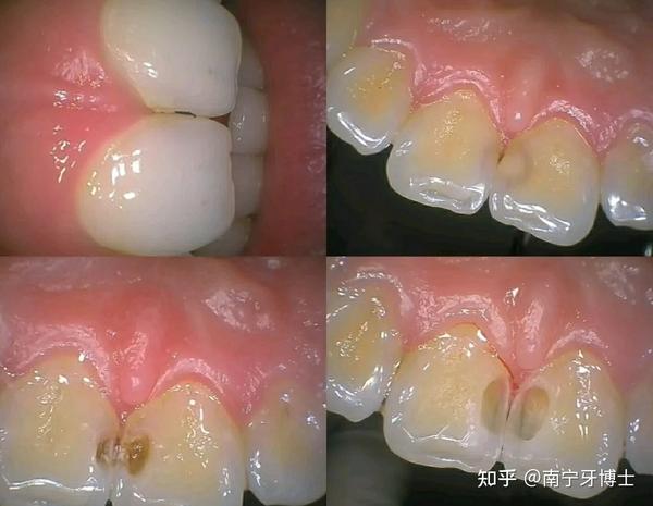 如果说在牙釉质比较