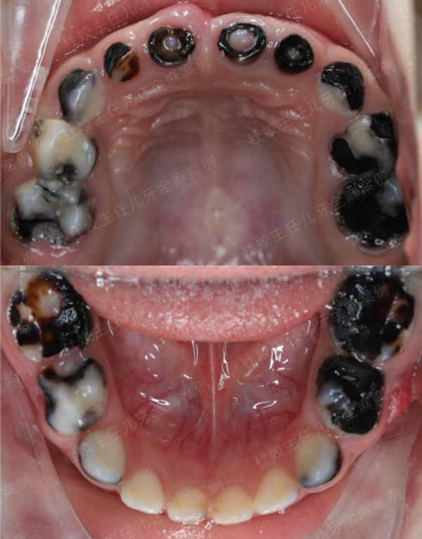 上前牙区4颗仅剩残根,多颗牙体发黑,后牙烂娉鱿