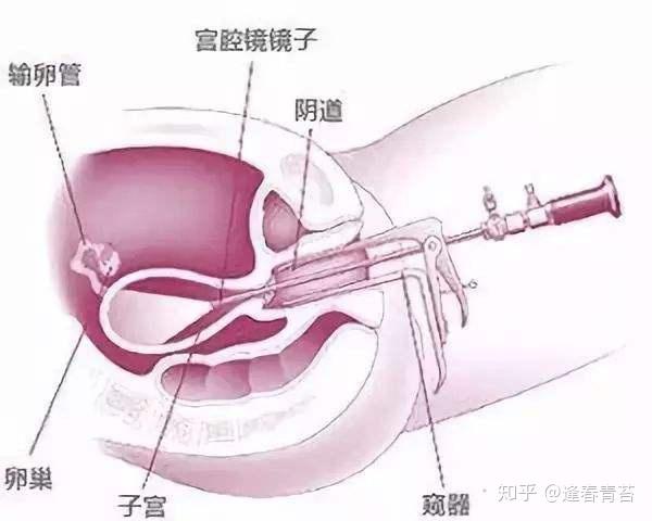 宫腔镜对不孕有很大帮助试管前一定要做吗