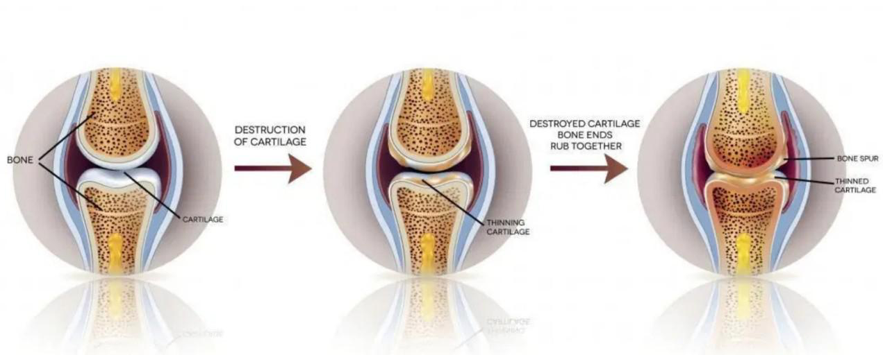 膝关节骨性关节炎的四个阶段