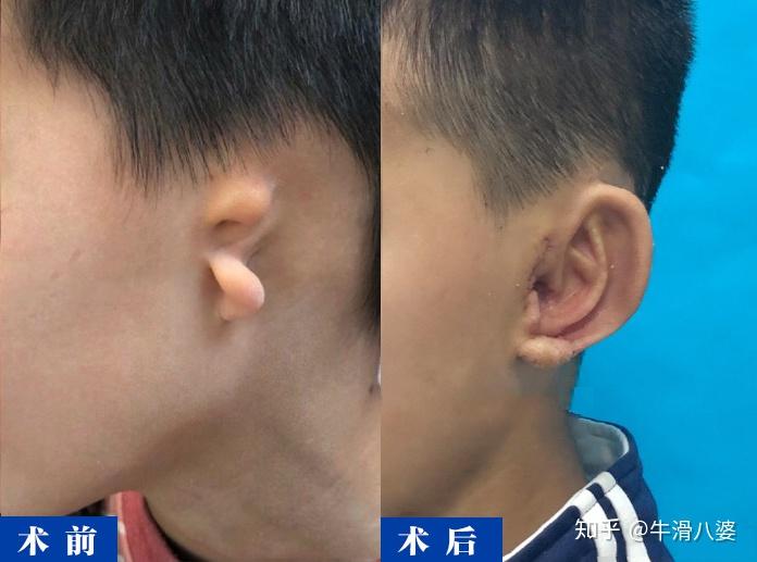 小耳畸形患者常见治疗方法