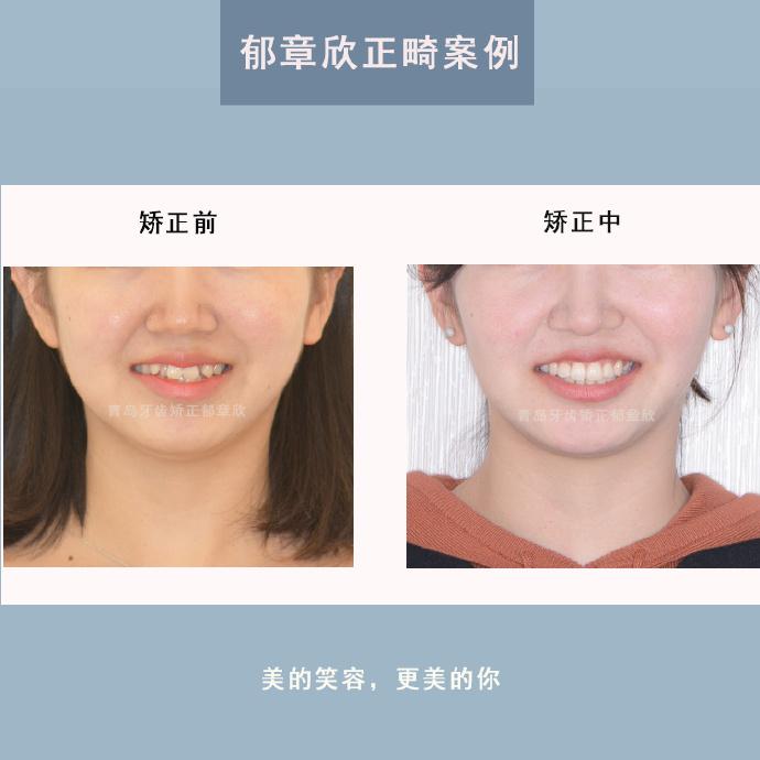 牙齿矫正郁章欣 南昌大学 口腔医学硕士 发布于 2020-07-08 赞同