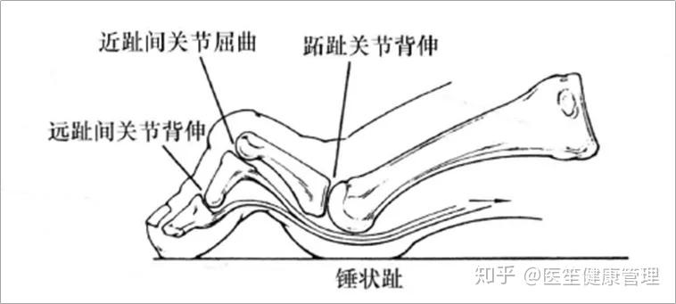 1,它们是什么样的形态 锤状趾 锤状趾如下图所示,这种畸形是跖趾关节