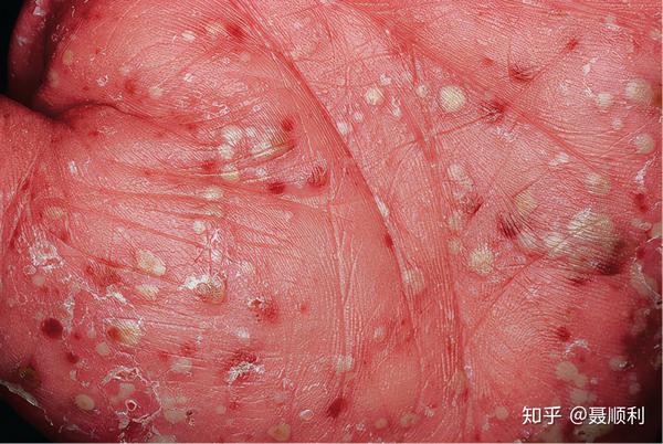 病(角层下脓皮病) 银屑病 毛囊闭锁三联征:聚合性痤疮,化脓性汗腺炎