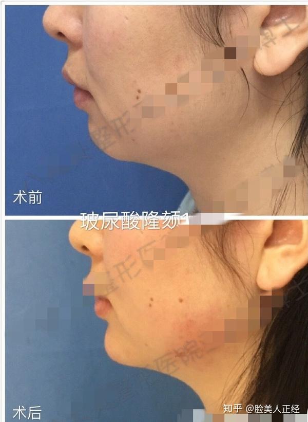 打过瘦脸针和玻尿酸的感受如何?