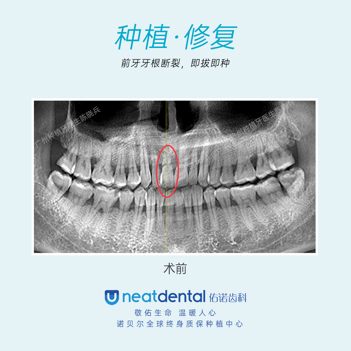 患者右上中切牙牙根断裂,cbct测量发现剩余牙根较短,不能保留,于是