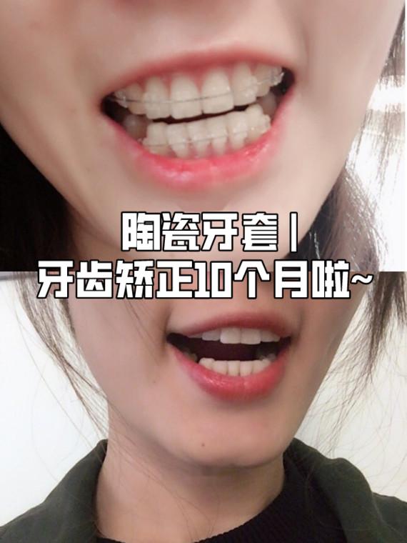 北京上海牙齿矫正多少钱?陶瓷牙套矫正10个月啦