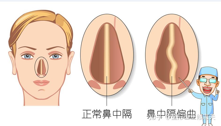 鼻中隔略左偏是什么意思?