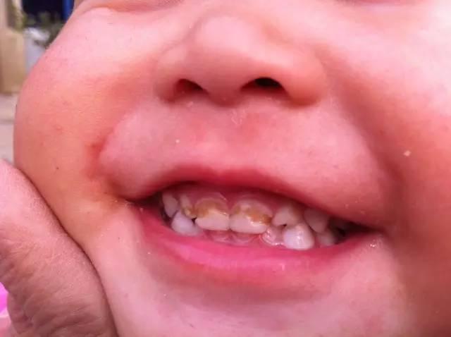 乳切牙的牙釉质菲薄,矿化程度较差,表面结构不成熟,本身抗龋能力就很