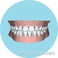 上颌的前牙还舌向倾斜,可能出现面下1/3高度较短及颏唇沟明显