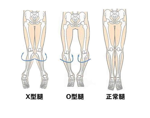 如何正确认识和治疗孩子的八字脚