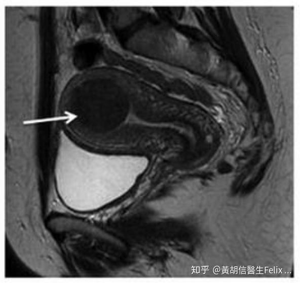 如何判断我是不是得了子宫肌瘤uterinefibroids