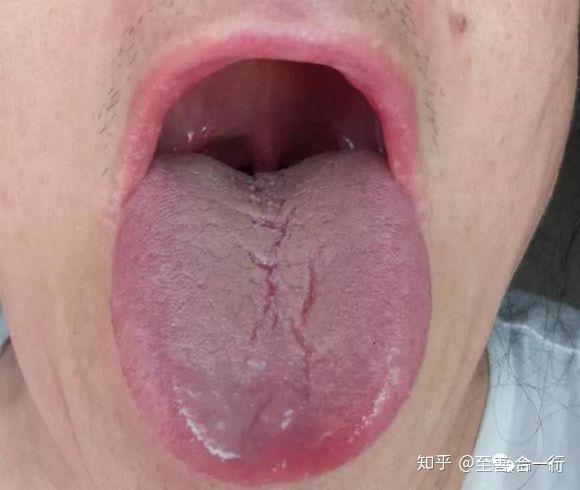 青色舌:舌头颜色有青色,多提示体内有寒,或者说血液的运行受阻,体内有