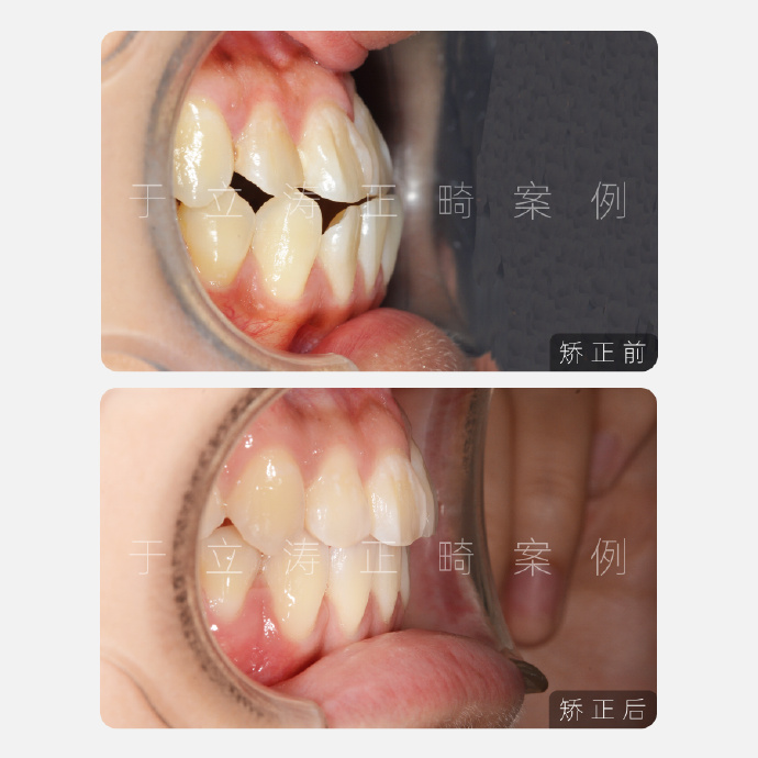 太原牙齿矫正于立涛地包天偏颌案例分享