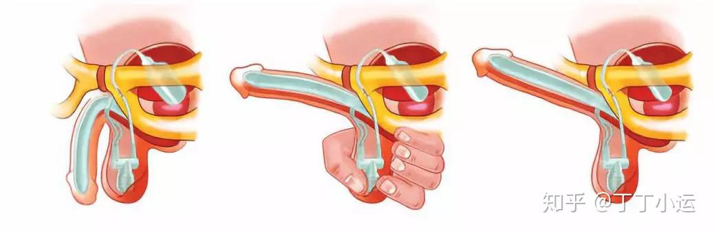 男人痿了也分心理性和器质性如何区分和治疗器质性勃起功能障碍