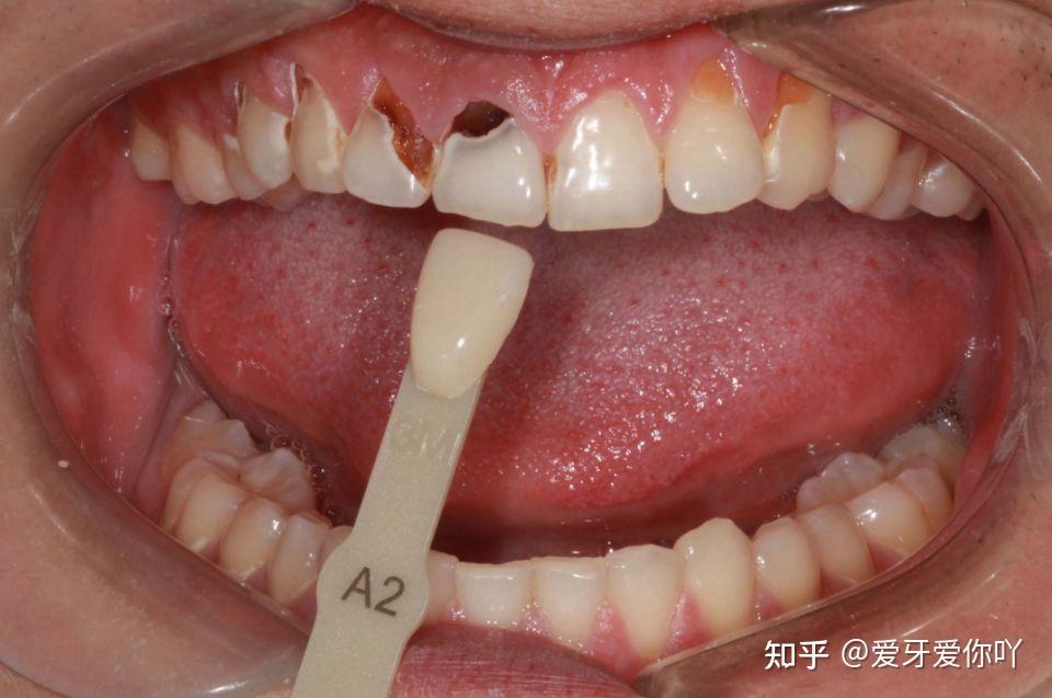喝可乐会损害牙齿吗