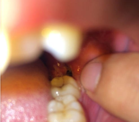 拔智齿后牙还老是疼,是得了干槽症?究竟要怎么解决?
