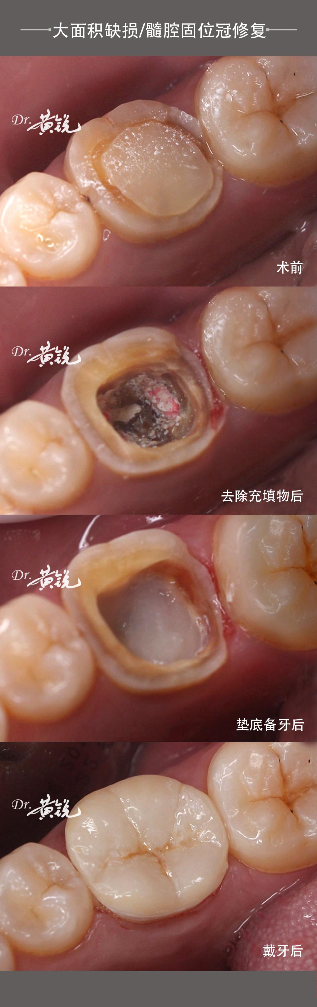 牙齿大面积缺损髓腔固位冠修复