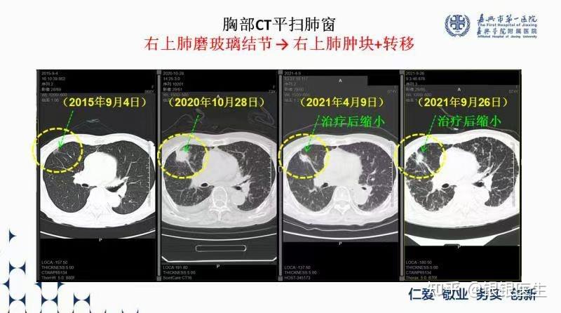 磨玻璃结节历时5年的变化