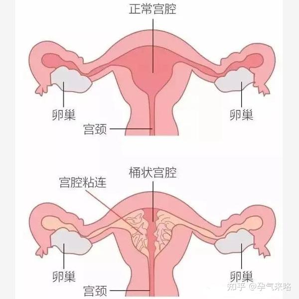 宫腔粘连是子宫内膜基底层受损后引起的子宫内膜纤维化疾病.