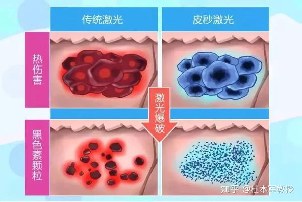 他来了他来了全能的皮秒激光来了