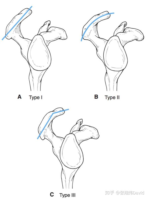 先天结构造成肩膀疼痛 肩关节受损的几率跟肩峰形状有关,可以将肩膀
