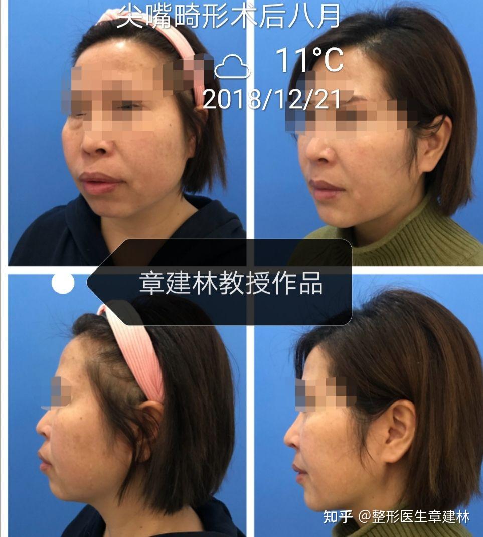 嘴巴凸怎么办