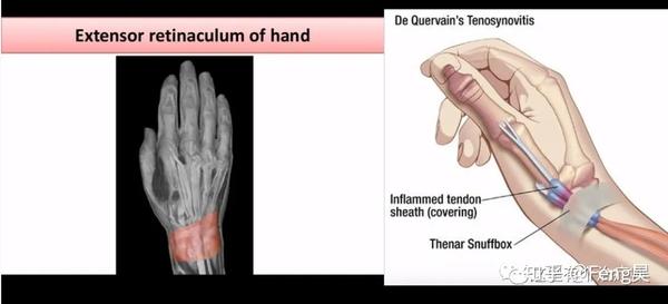 【运动损伤respond】第三期 | "妈妈手"-桡骨茎突狭窄性腱鞘炎