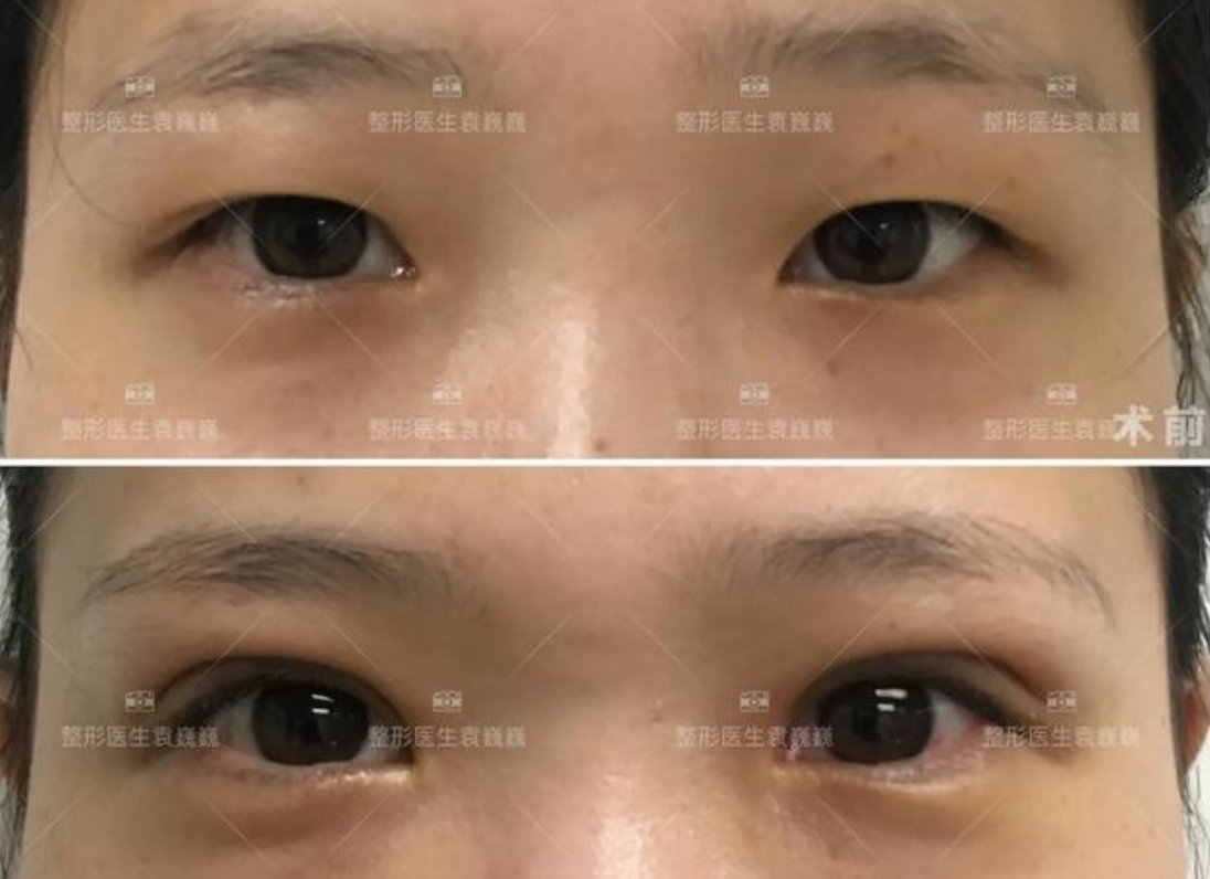 袁医生双眼皮案例6肿眼泡做双眼皮效果一样可以很好