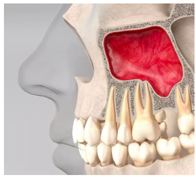 上颌窦后牙牙根上方的天花板为啥在种植牙手术中很重要