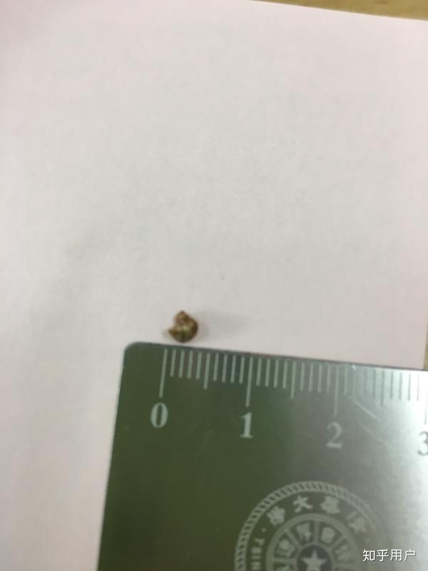 2天排出肾结石 知乎