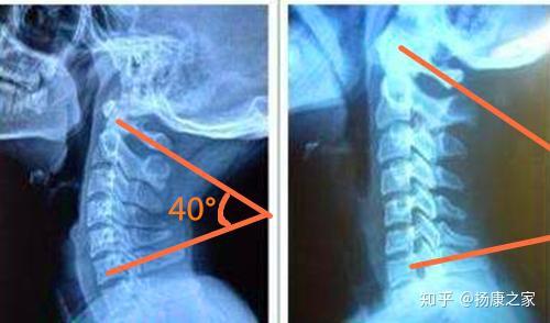 颈椎痛就是曲度变直了吗?如何准确的判断颈椎曲度的变化?