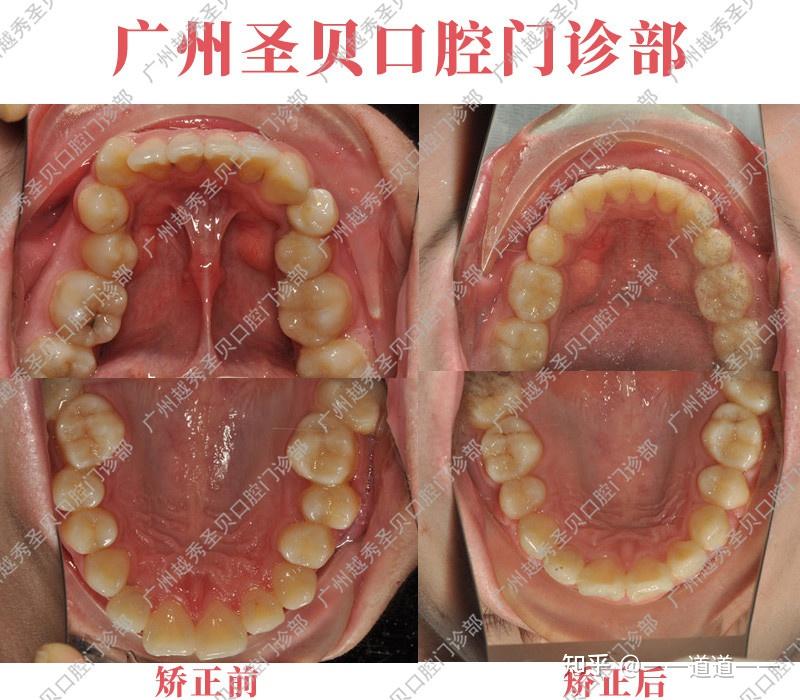 广州圣贝牙齿矫正案例分享牙齿不齐前牙深覆盖治疗