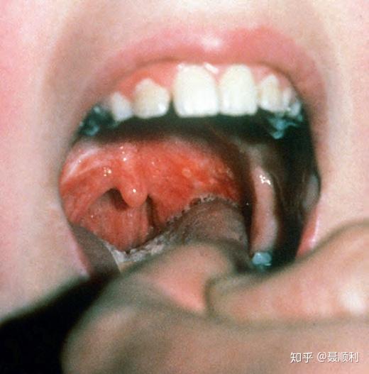 受累区域最常位于腭舌弓,软腭,扁桃体和悬雍垂.