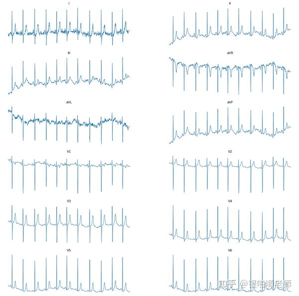 12通道心电图