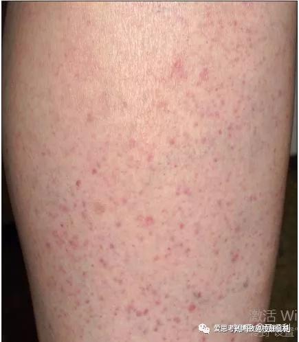 2,皮肤与黏膜病变; 皮肤的异常干燥和瘙痒是常见症状;13%-30%的干燥