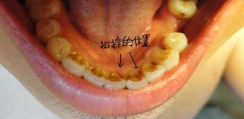 洗牙特别伤牙,还会让牙齿变松?