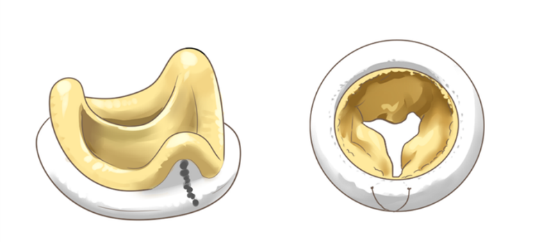一图就懂丨心脏瓣膜置换机械瓣和生物瓣哪个好