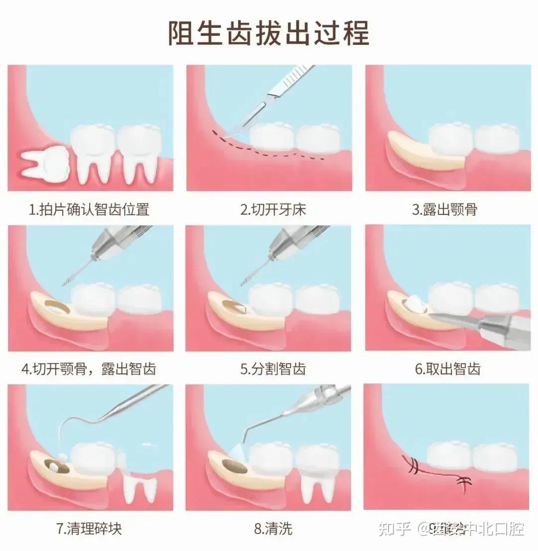 建议上下四个智齿一起拔除;一般一侧拔除后 1～2 周,拔牙伤口完全愈合