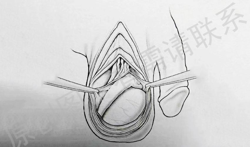 睾丸位于阴囊内,一般左侧略低于右侧.