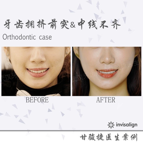 甘骏捷的正畸唠嗑:牙齿拥挤前突,中线不齐