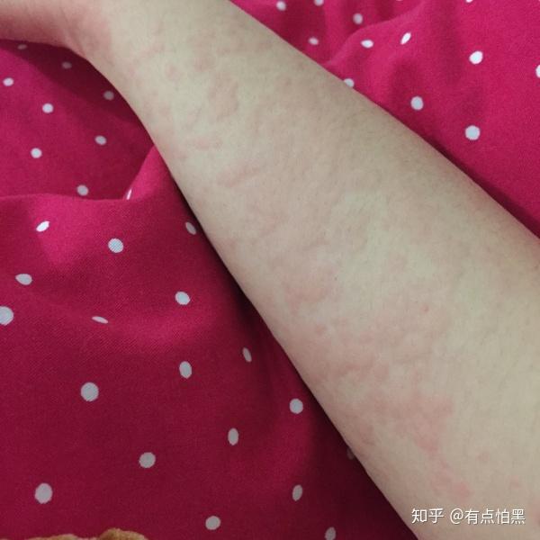 荨麻疹有治好的吗?