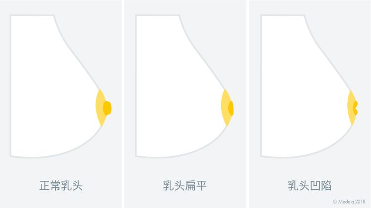 现在怀孕5个月了可我乳头内陷要怎么给宝宝喂奶