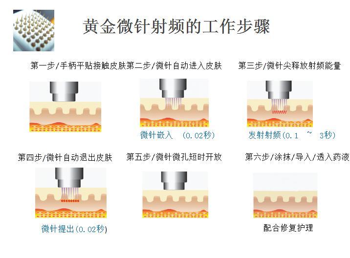 什么是黄金微针