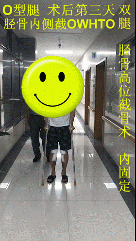 大汇总ox型腿膝内外翻矫正专业科普 膝内翻o型腿-胫骨
